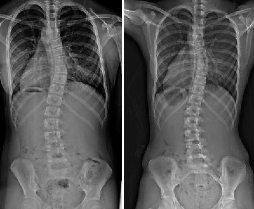 scoliosis